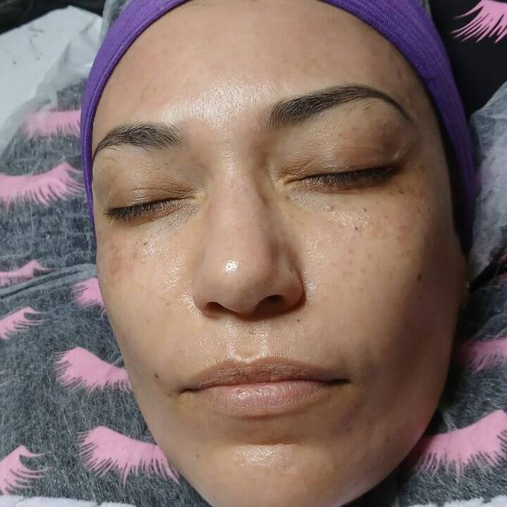 Microagulhamento facial